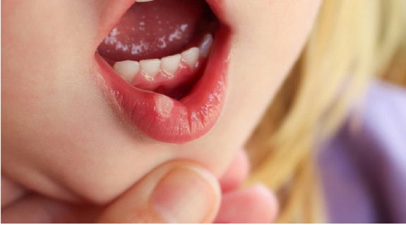 Loét miệng: Dùng thuốc an toàn và cách phòng ngừa - Ảnh 2.