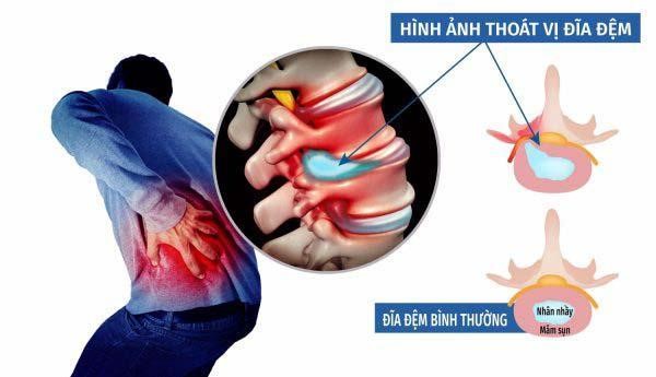 Tìm hiểu nguyên nhân và cách nhận biết bệnh thoát vị đĩa đệm - Ảnh 1.