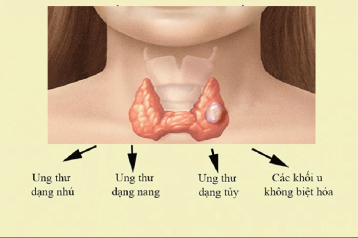 Ung thư tuyến giáp: Sự phát triển của khối u và chẩn đoán mô bệnh học