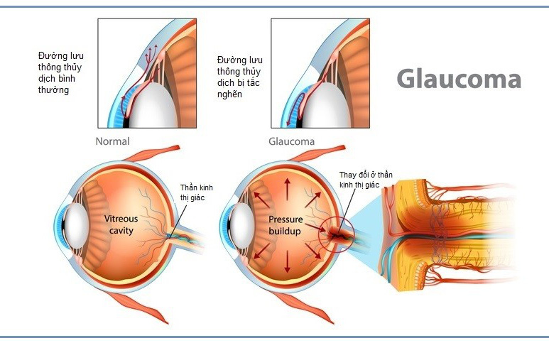 Glaucoma - "Kẻ đánh cắp" thị giác thầm lặng