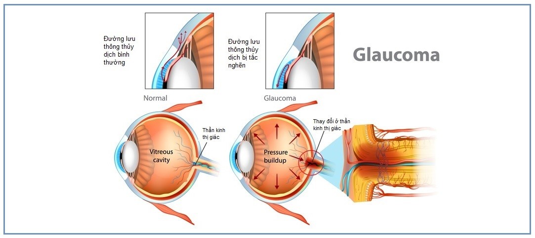 Glaucoma - “Kẻ đánh cắp” thị giác thầm lặng - Ảnh 3.
