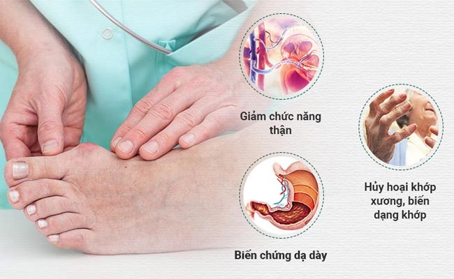 Bệnh gút (gout) và cách phòng ngừa, điều trị hiệu quả