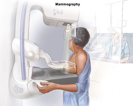 Chụp nhũ ảnh/chụp X-quang tuyến vú (Mammography) tầm soát ung thư vú