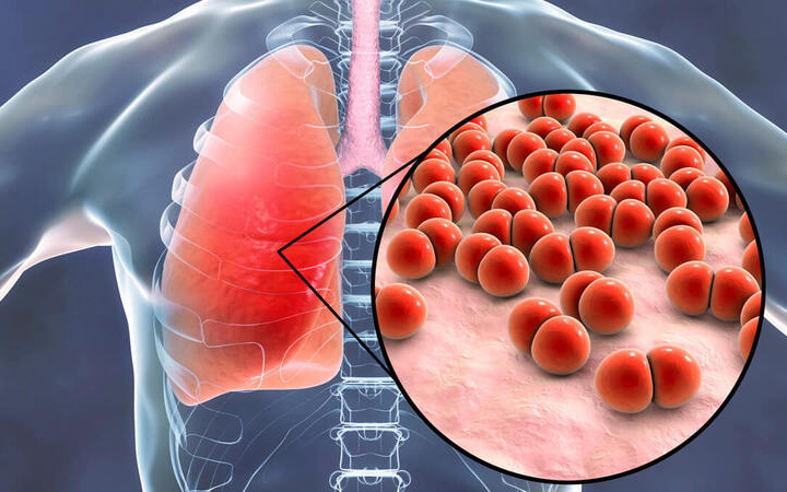 Xơ phổi ảnh hưởng đến sức khỏe như thế nào?- Ảnh 3. Xơ phổi kẽ vô căn dùng thuốc gì?