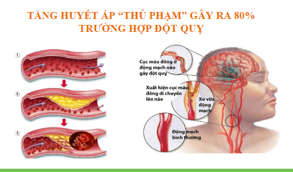 Biện Pháp Phòng Ngừa và Kiểm Soát Cao Huyết Áp