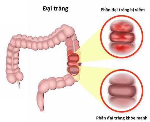 Bài thuốc trị viêm đại tràng mạn thể thấp nhiệt - Ảnh 1.