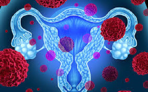 Ung thư buồng trứng: Dấu hiệu, nguyên nhân và phương pháp điều trị