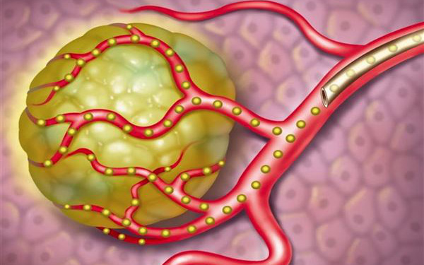 Nút mạch trong điều trị ung thư gan nguyên phát thực hiện khi nào?