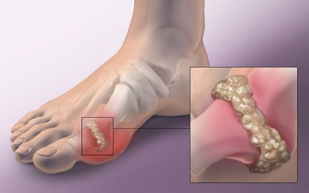 Trị gout bằng y học cổ truyền như thế nào?