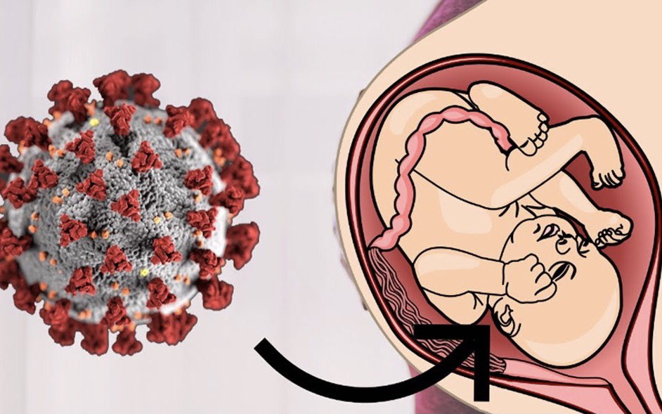 Nguy cơ sinh non ở những phụ nữ mang thai bị nhiễm COVID-19 nặng