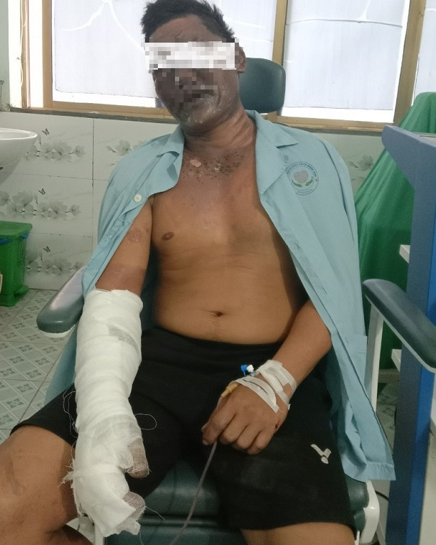 Biến dạng mặt do nổ bình gas mini  - Ảnh 1.