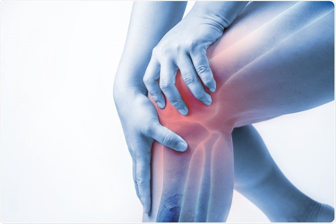 Thoái hóa khớp gối nên làm gì?- Ảnh 2.