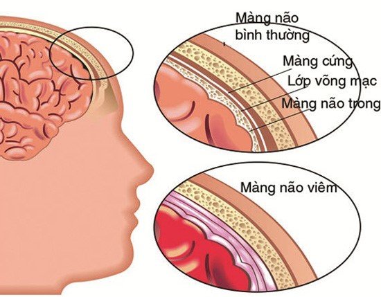 Viêm não cấp ở trẻ em: Dấu hiệu nhận biết, nguyên nhân và những lưu ý - Ảnh 2.