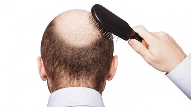 Phương pháp chữa rụng tóc ở nam giới hiệu quả