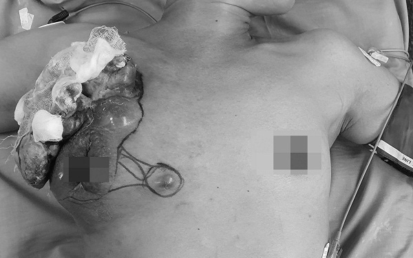 Khối u vú sùi loét, bốc mùi hôi thối vì không chịu đi khám