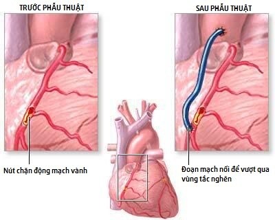 Phẫu thuật bắc cầu động mạch vành: Giải pháp tối ưu giảm thiểu nguy cơ nhồi máu cơ tim  - Ảnh 3.