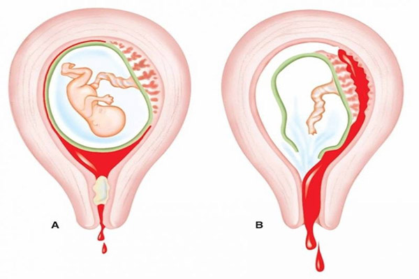 Sót nhau thai sau sinh: Nguyên nhân, triệu chứng và cách xử lý - Ảnh 1.