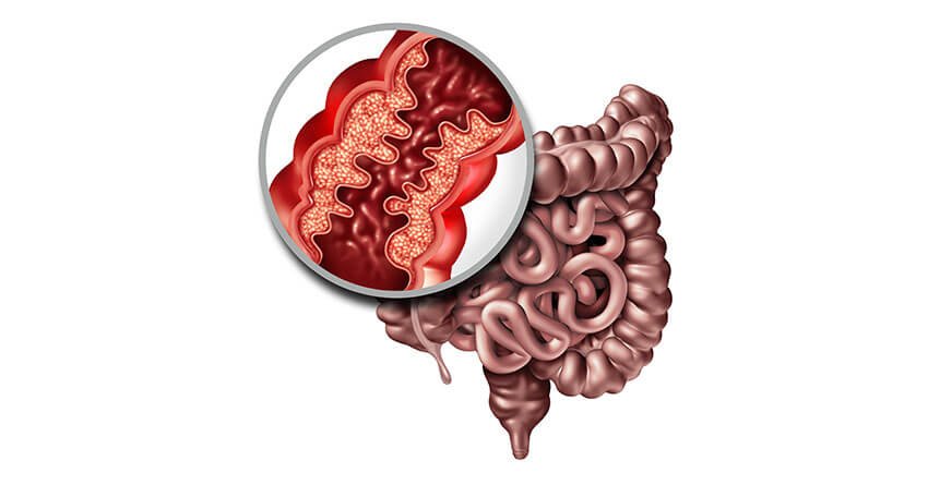 Bệnh Crohn có thuốc điều trị? - Ảnh 1.