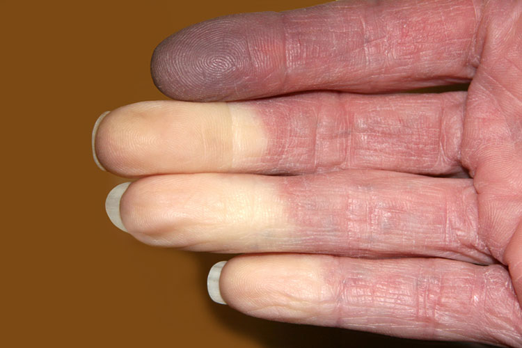 Triệu chứng của Bệnh Raynaud