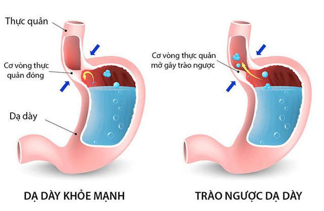 Trào ngược dạ dày thực quản gây nhiều biến chứng nếu không được điều trị sớm, dứt điểm - Ảnh 1.