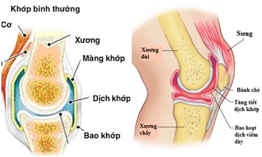 Viêm màng bao hoạt dịch khớp: Tiến triển biến chứng và cách phòng bệnh - Ảnh 2.