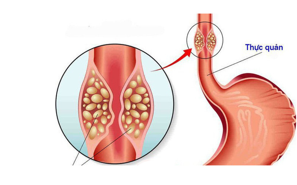 Ung thư thực quản: Biện pháp điều trị, cách chăm sóc và phòng ngừa