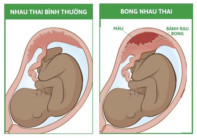 Huyết áp bất thường khi mang thai có đáng lo ngại? - Ảnh 2.