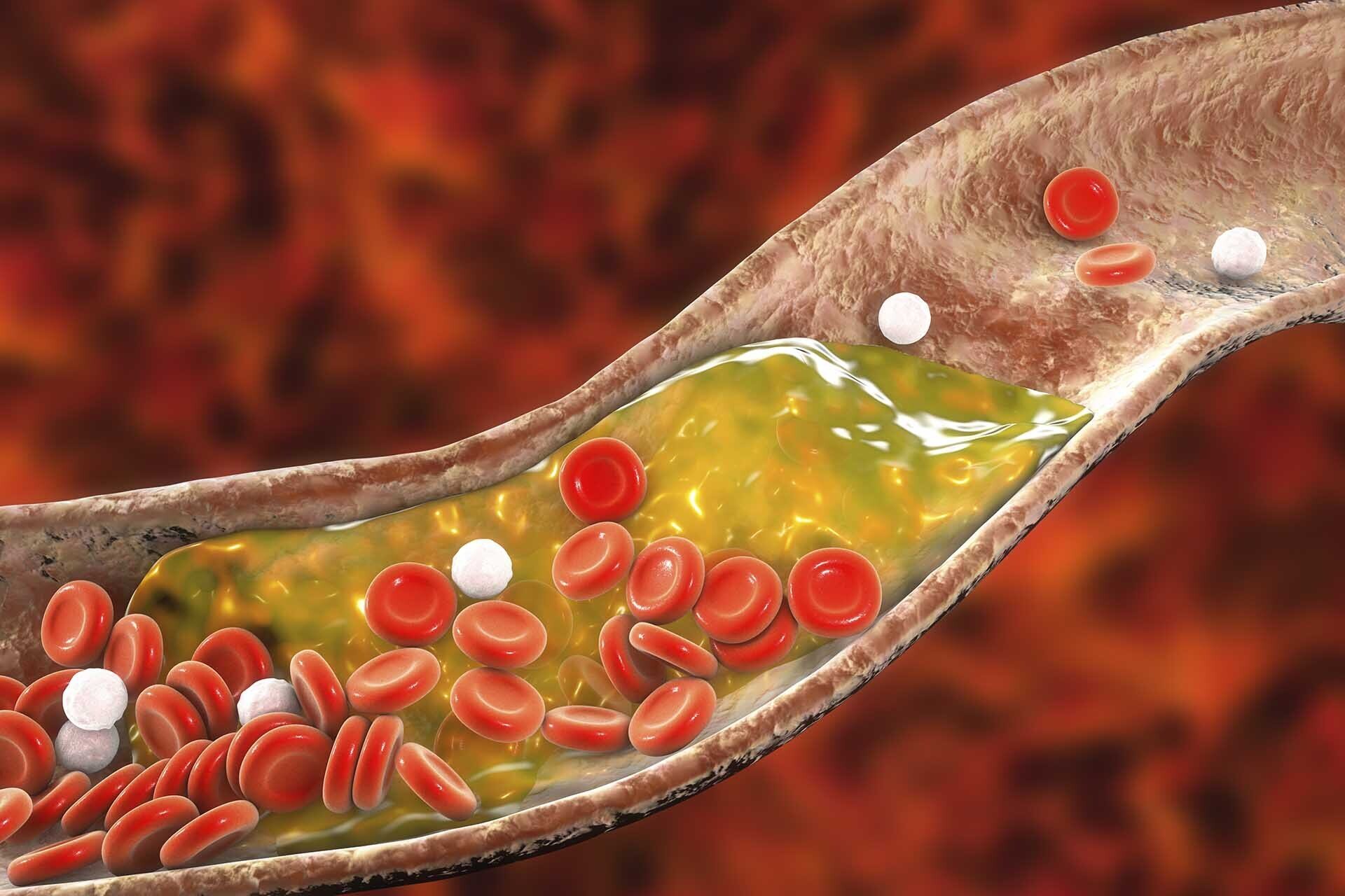 Cholesterol: Thủ phạm gây ra những bệnh lý về tim mạch cần lưu ý - Ảnh 1.