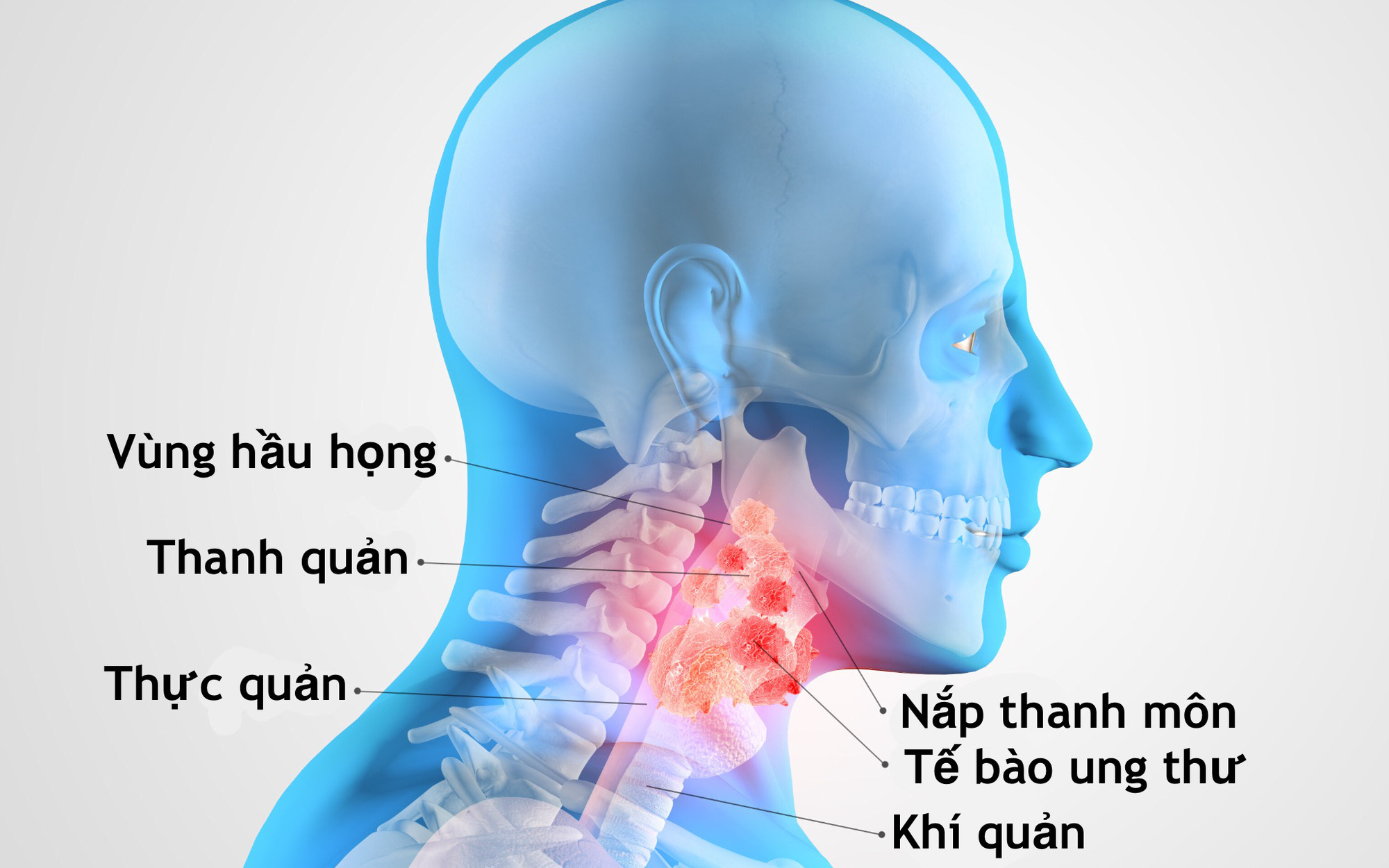 Thở khò khè, ho cảnh giác với ung thư khí quản