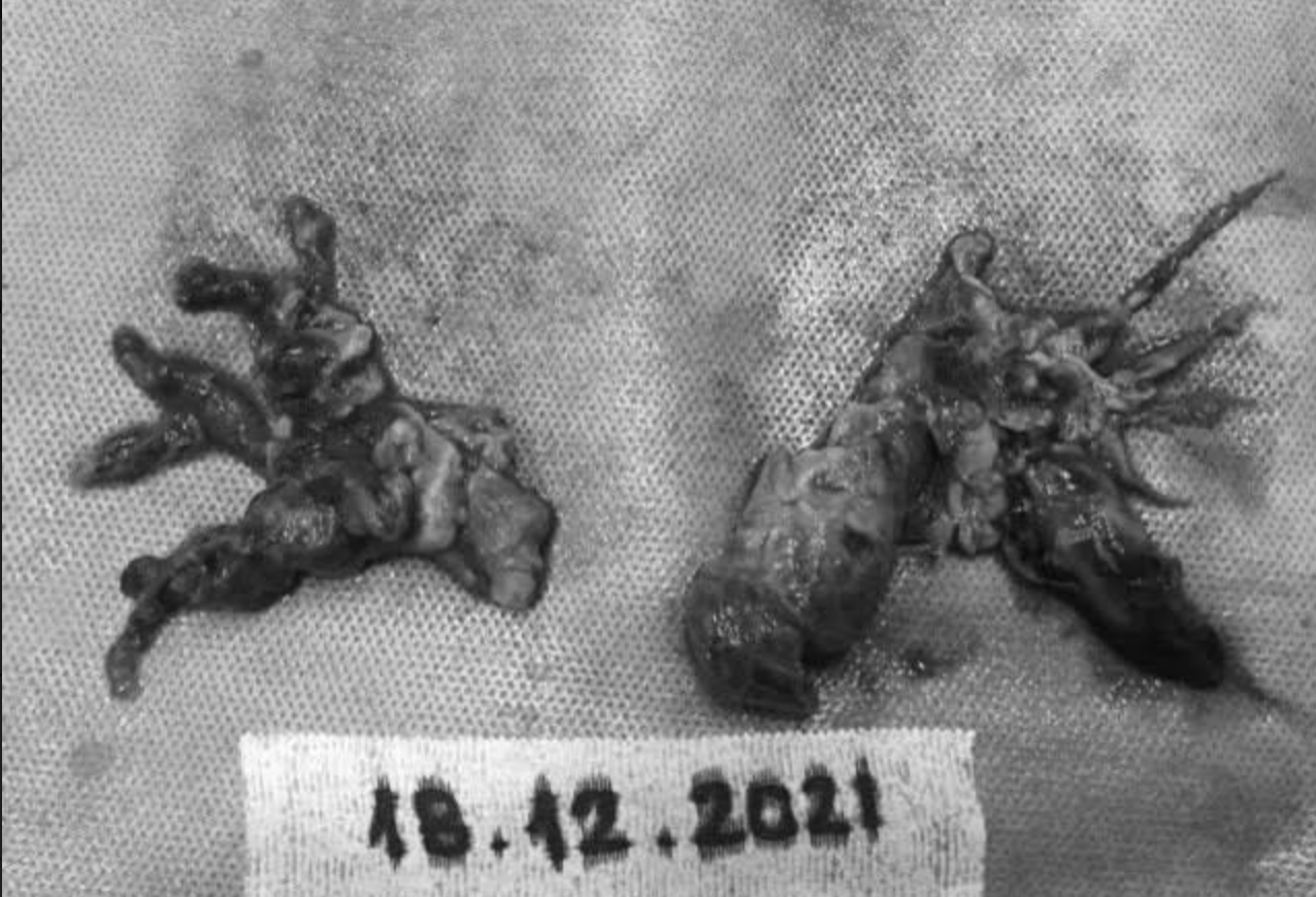 Cấp cứu bệnh nhân thuyên tắc phổi, ngưng tim sau mắc COVID-19  - Ảnh 1.