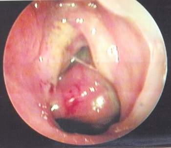 U xơ mạch vòm mũi họng: Nguyên nhân, chẩn đoán và điều trị - Ảnh 1.