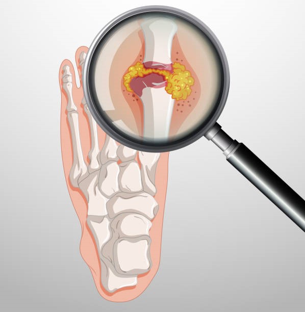 Hỗ trợ kiểm soát gout mạn tính nhờ sản phẩm thảo dược - Ảnh 1.