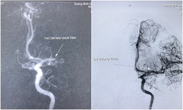 Ứng dụng phần mềm trí tuệ nhân tạo cứu sống người bệnh đột quỵ não - Ảnh 3.