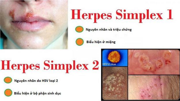 Herpes dễ nhầm lẫn với 4 bệnh ở đường sinh dục
