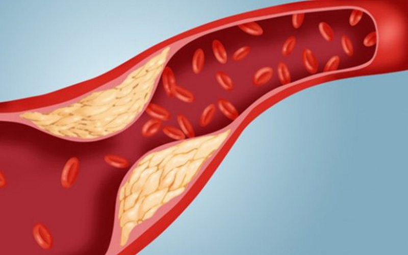 Hiểu đúng về cholesterol để phòng bệnh mỡ máu cao