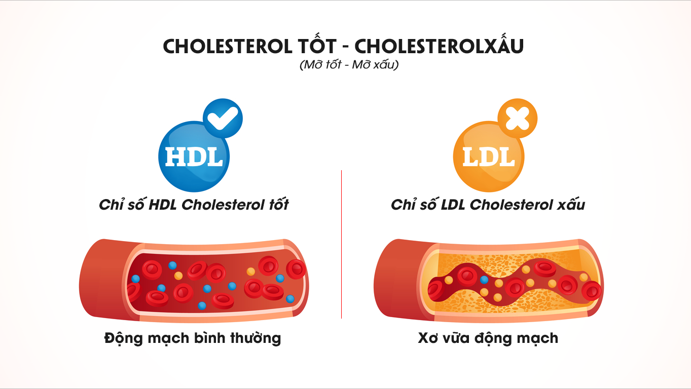 Cholesterol cao đẩy nhanh tốc độ xơ vữa mạch vành, thiếu máu cơ tim