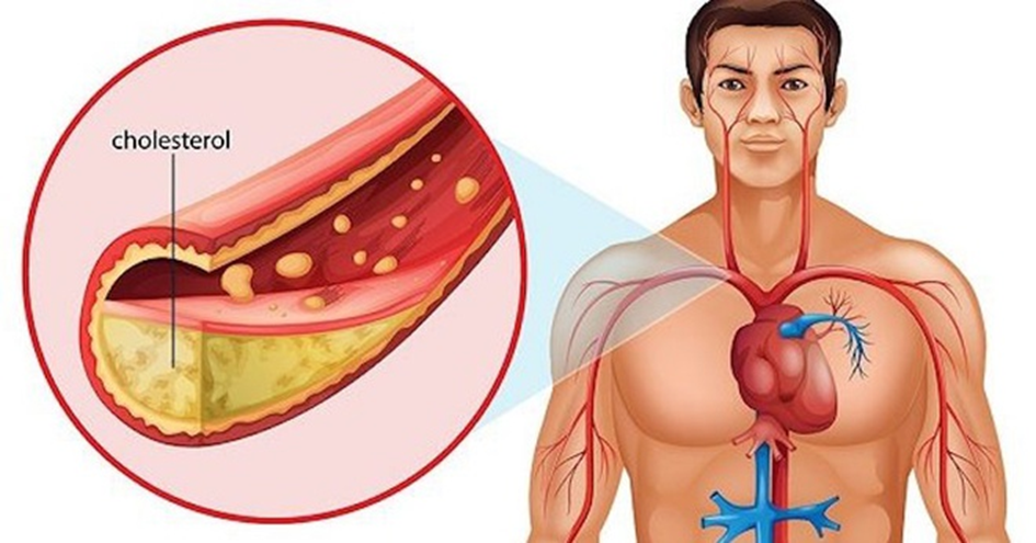 Cholesterol cao đẩy nhanh tốc độ xơ vữa mạch vành, thiếu máu cơ tim