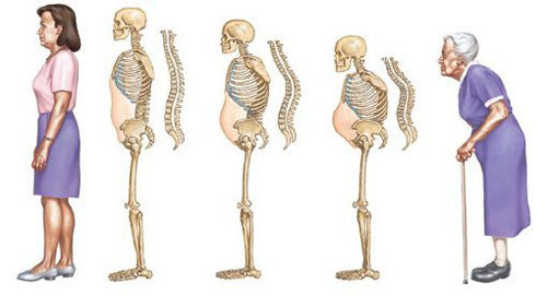 Phụ nữ sau thời kỳ mãn kinh, loãng xương là một vấn đề rất đáng quan tâm, vì qui mô và hệ quả nghiêm trọng của bệnh.