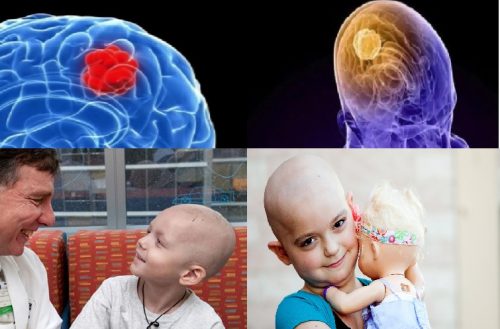 Bệnh u não ở trẻ em: Nhận biết, nguyên nhân và những lưu ý - Ảnh 2.