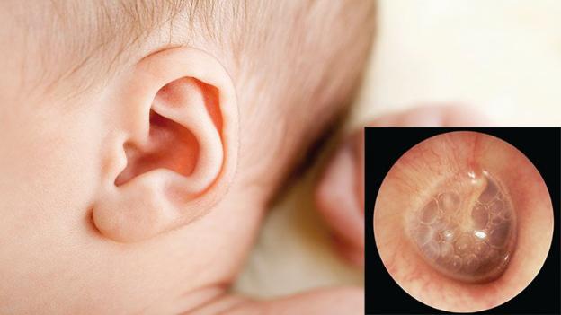 Viêm tai giữa tiết dịch ở trẻ: Nhận biết, nguyên nhân, điều trị, phòng ngừa