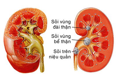 Bài thuốc phòng và trị sỏi đường tiết niệu