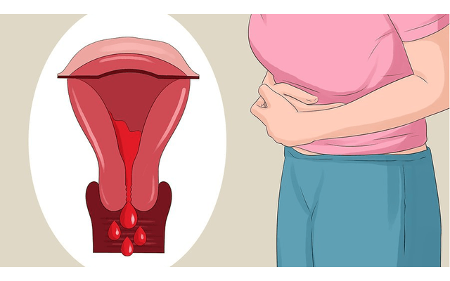 Niêm mạc tử cung lạc chỗ và dấu hiệu nhận biết sớm