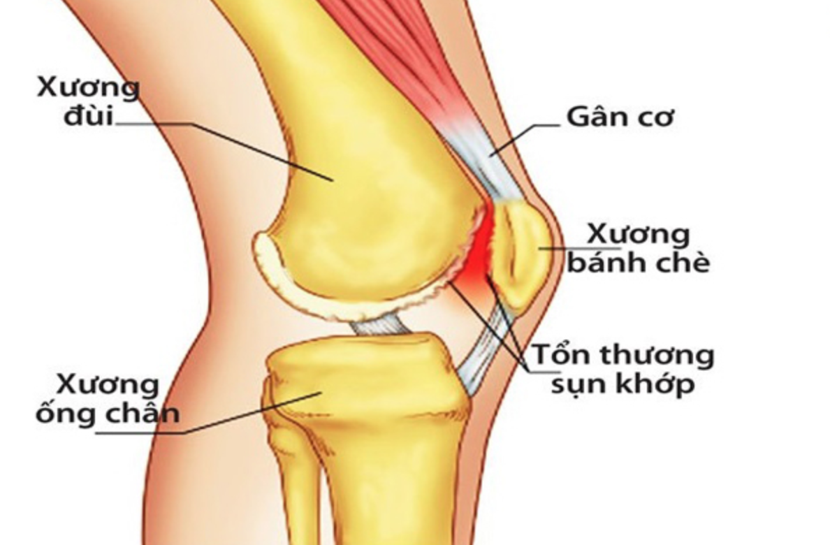 Hiếm gặp: Bệnh lý xương bánh chè hai mảnh cả hai gối - Ảnh 1.