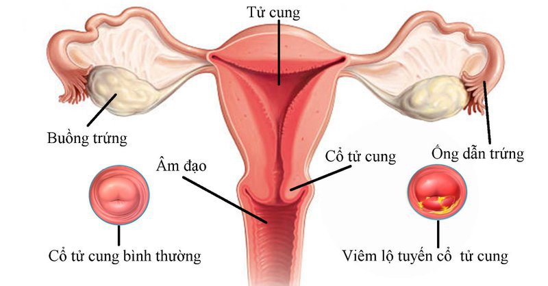 Viêm lộ tuyến cổ tử cung khi mang thai ảnh hưởng đến thai phụ và thai nhi thế nào? - Ảnh 1.