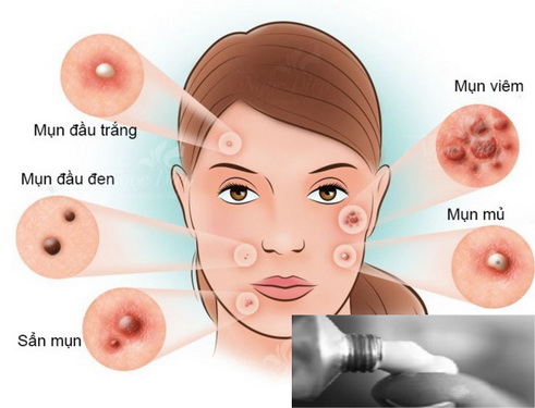 Thêm một lựa chọn điều trị cho người bị mụn trứng cá - Ảnh 1.