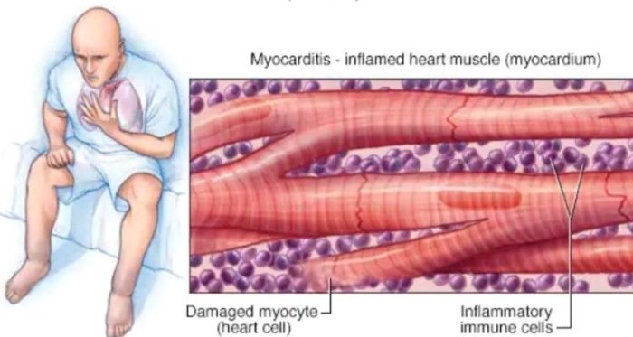 Viêm cơ tim sau tiêm vaccine phòng COVID-19 có đáng ngại? - Ảnh 2.