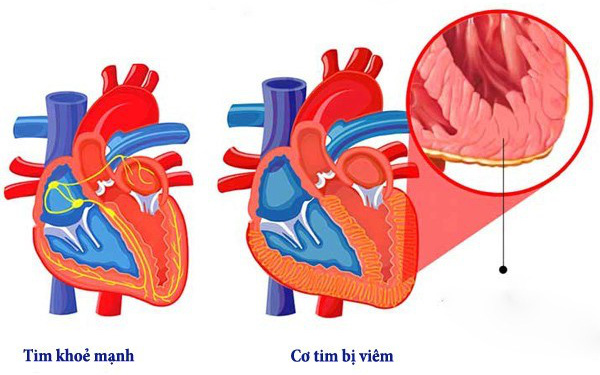 Cảnh giác với bệnh viêm cơ tim ở trẻ