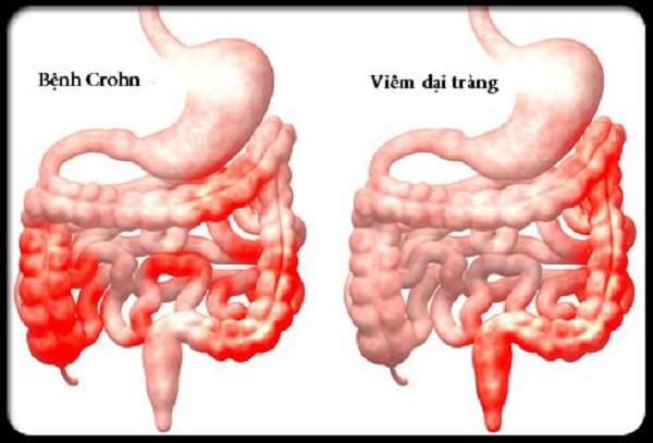 Bệnh nhân viêm ruột mạn tính có thể tiêm vaccine ngừa COVID-19 không? - Ảnh 1.