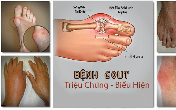 Thực phẩm - thuốc tốt cho người bệnh gút 