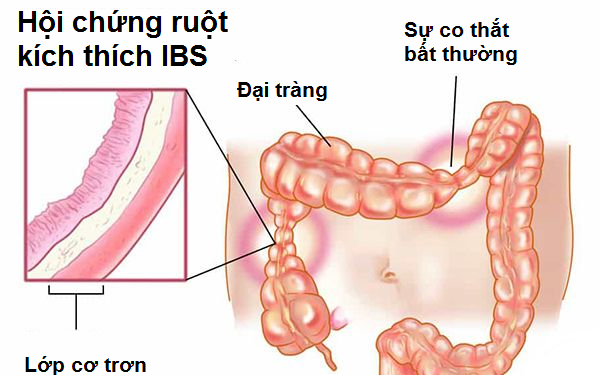 Trị hội chứng ruột kích thích như thế nào?